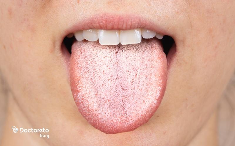 دلایل سفید شدن زبان، درمان و پیشگیری از آن