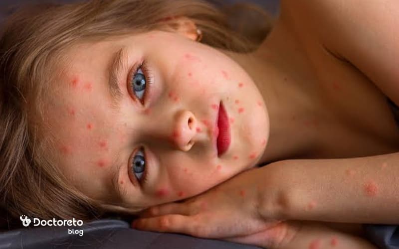 علائم آبله مرغان را بشناسیم