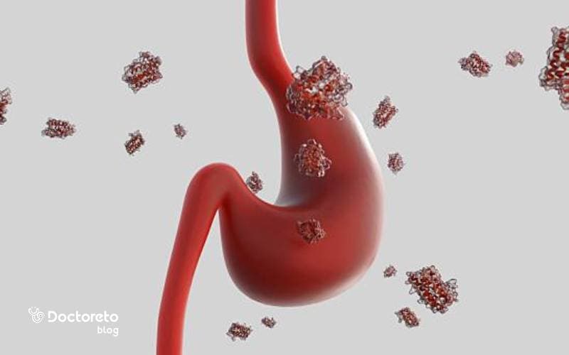 سرطان معده چیست؟ تمام آنچه باید از سرطان معده بدانید