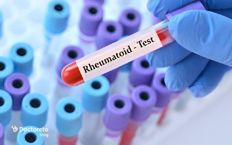 آزمایش روماتیسم در برگه آزمایش و تحلیل نتیجه آن