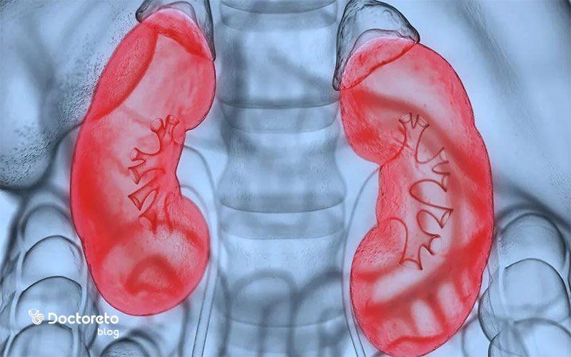 سندروم نفروتیک کلیه و روش های درمان آن