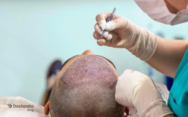 کاشت مو به روش fue: مزایا، عوارض و روش انجام آن