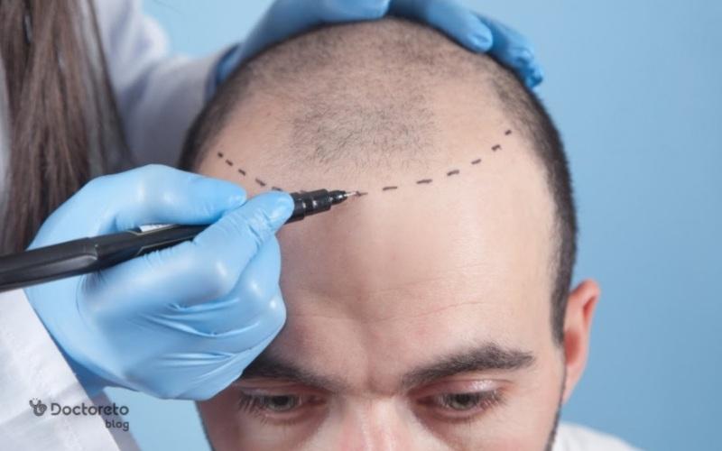 کاشت مو به روش FIT چگونه انجام می‌ شود؟ مزایا، معایب و نحوه انجام آن