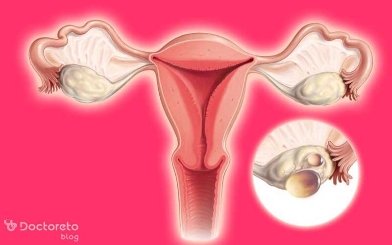 فرق تنبلی تخمدان خفیف و شدید از نظر علائم و درمان