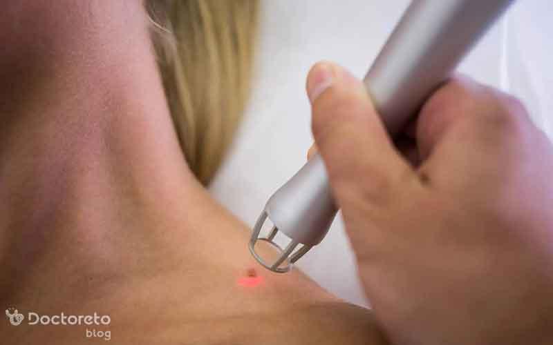 برداشتن خال با لیزر برای چه افرادی مناسب است؟