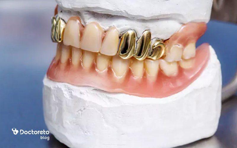 روکش فلزی دندان چیست و چه کاربردی دارد؟