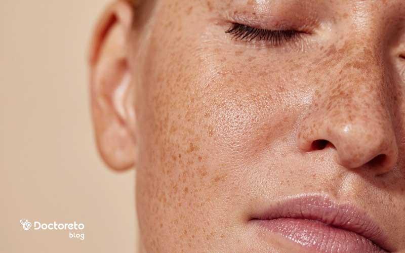 آیا میکرونیدلینگ برای لک صورت درمانی مؤثر است؟