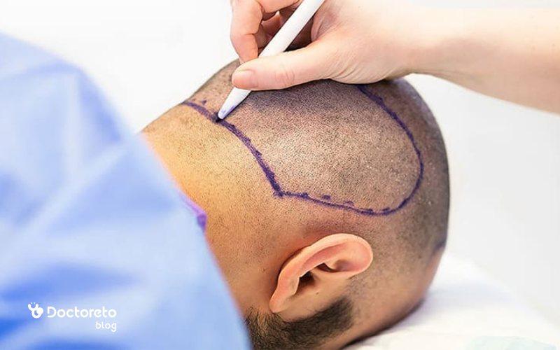 کاشت مو چند ساعت طول میکشد؟