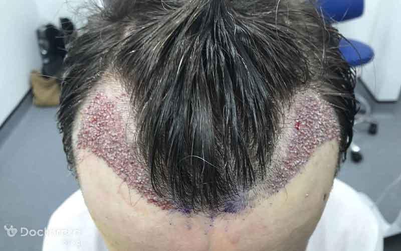 بررسی قدم به قدم مراحل کاشت مو