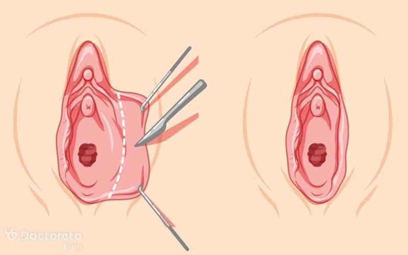 گوشت اضافه بعد از لابیاپلاستی به چه دلیلی ایجاد می شود؟