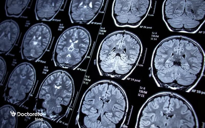 همه آنچه باید از ضایعه مغزی بدانید