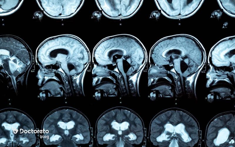 همه آنچه از مایع مغزی نخاعی باید بدانید.