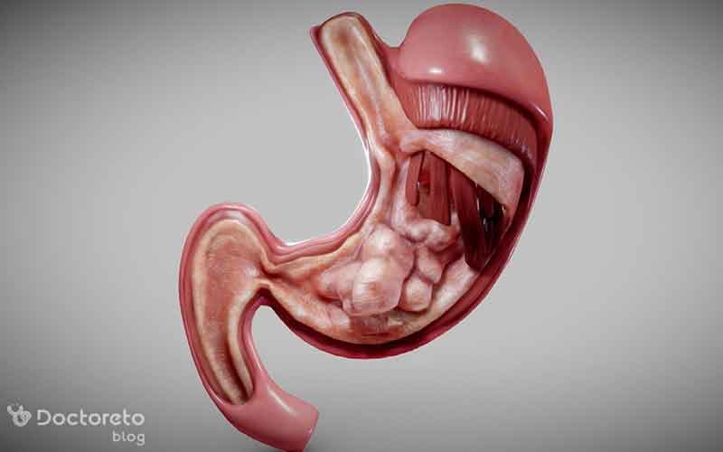 همه‌ چیز درباره سرطان معده خوش خیم