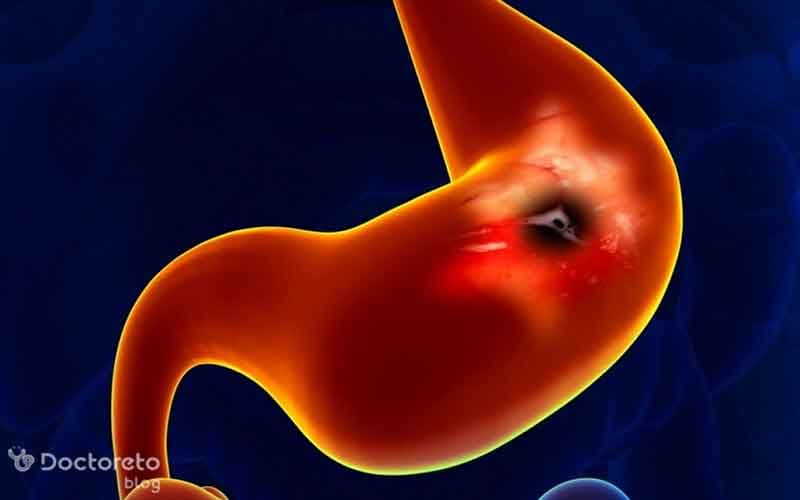 انواع داروهای سرطان معده خوش خیم چه هستند؟