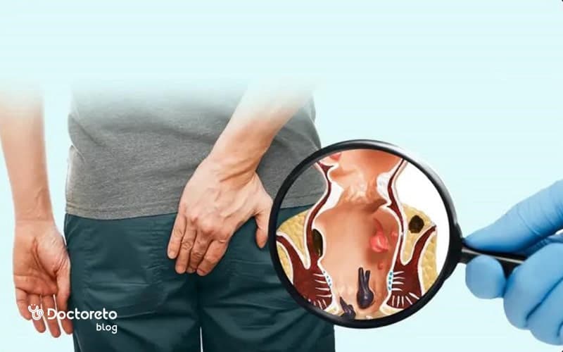 فیستول مویی چیست؟