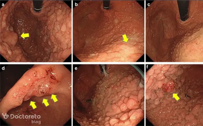 عکس سرطان معده بدخیم و کاربرد آن در تشخیص