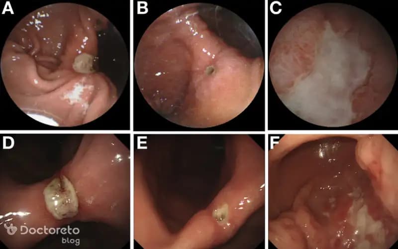 عکس سرطان معده خوش خیم و کاربرد آن در تشخیص