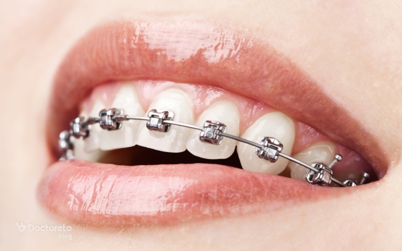 ارتودنسی ثابت، پرکاربردترین روش ارتودنسی دندان