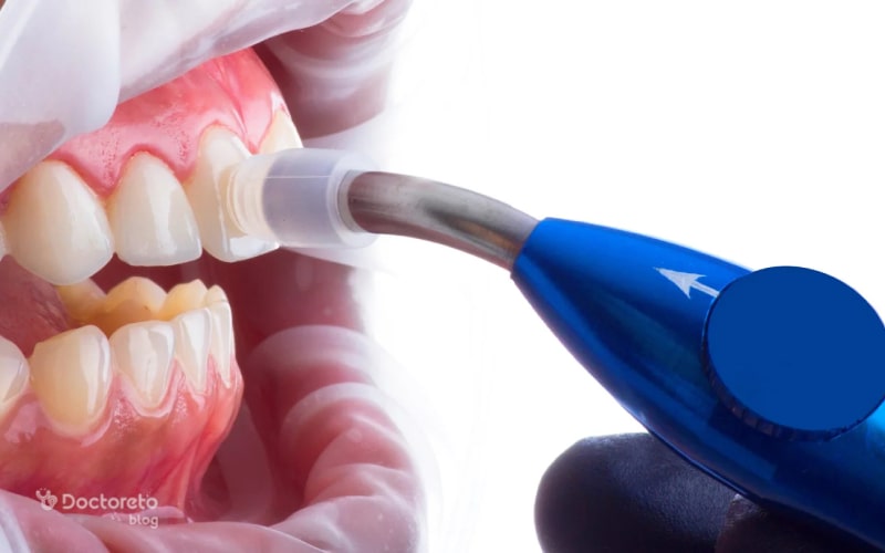 کامپوزیت ips راهکاری پیشرفته و موثر برای ترمیم دندان ها