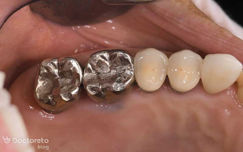 روکش استیل دندان چه کاربردی برای دندان شیری و دائمی دارد؟