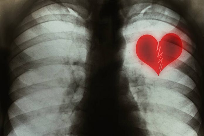 Broken-heart-syndrome Broken-heart-syndrome