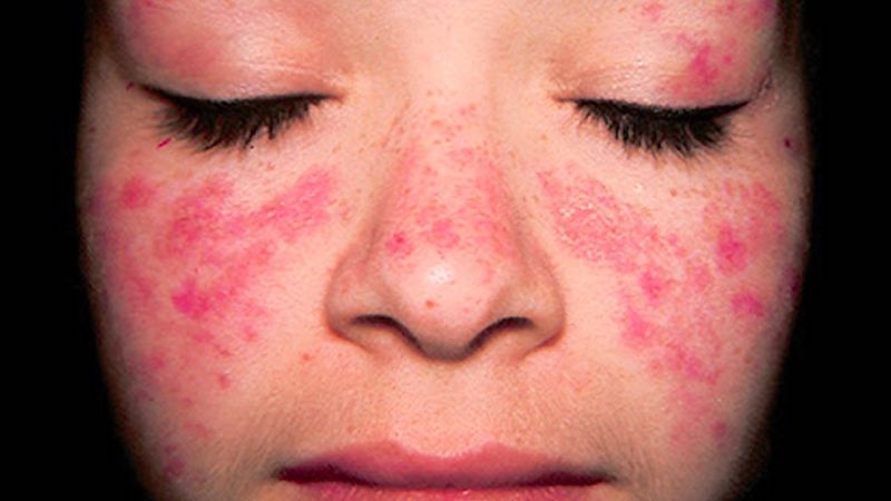بیماری لوپوس - خارش پروانه‌ای پوست صورت