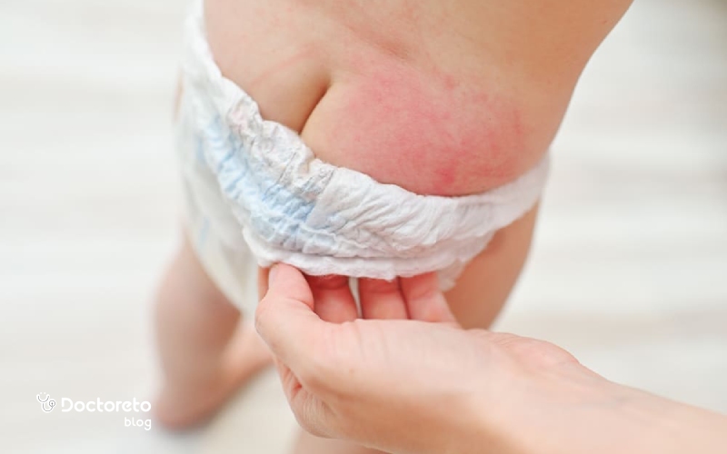 پوشک درماتیت (Dermatitis) یا التهاب پوشک