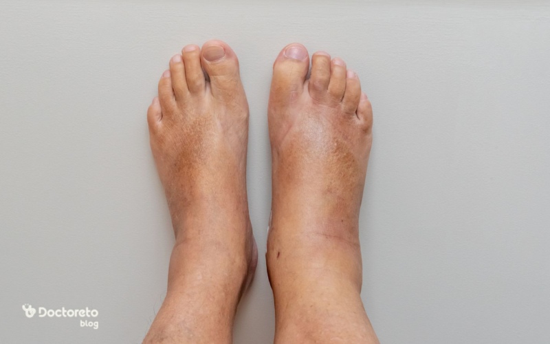 ورم پا نشانه چیست؟ بررسی علل شایع و خطرناک تورم پا