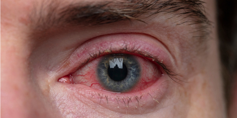 قرمزی چشم به علت آلرژی هم می تواند باشد. 