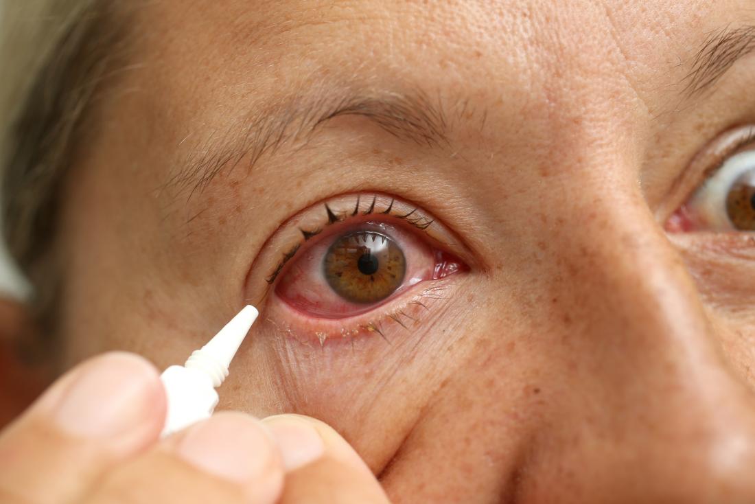 قطره برای درمان قرمزی چشم مناسب است. 