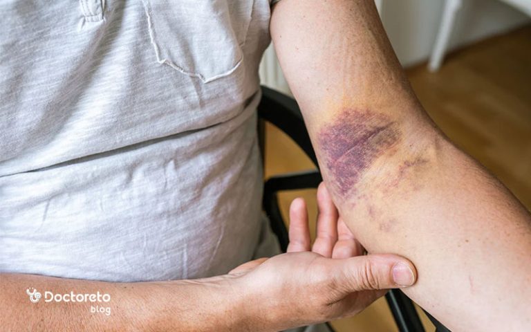 علت کبودی ناگهانی بدن چیست و چگونه می توان آن را رفع کرد؟