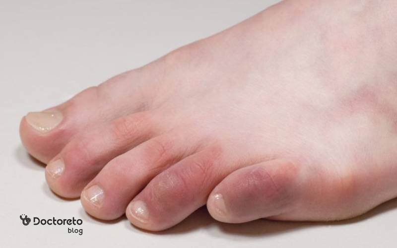 سرمازدگی انگشتان پا و دست