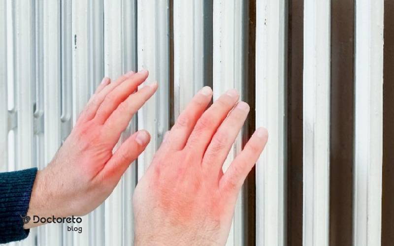 درمان یخ زدگی دست