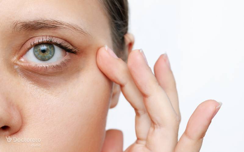 علت سیاهی دور چشم چیست و چگونه آن را درمان کنیم؟
