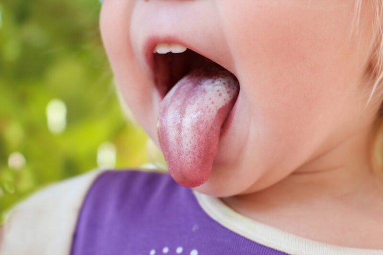 برفک دهانی در کودکی که زبانش را از دهان بیرون آورده است