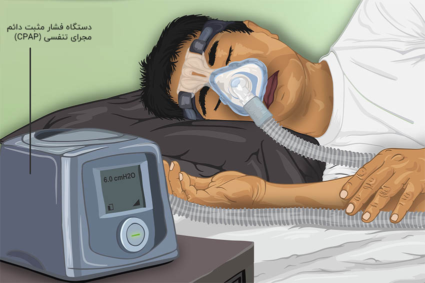 دستگاه فشار مثبت دائم مجرای تنفسی CPAP