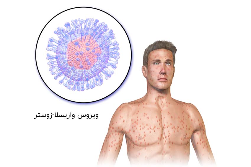 علائم آبله مرغان چیست و چه درمانی دارد مجله سلامت دکترتو