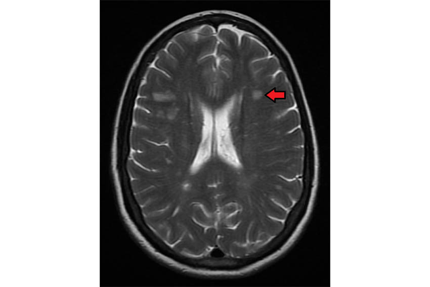 یکی از روش‌های تشخیص MS، انجام MRI از مغز است.