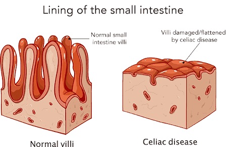 بیماری سلیاک یک بیماری خودایمنی است که در آن سلولهای خود بدن به پرزهای روده حمله می کنند.