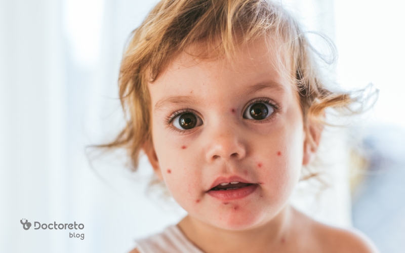 علائم اولیه آبله مرغان در کودکان