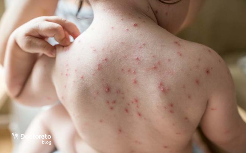 شکل جوشهای ابله مرغان عکس