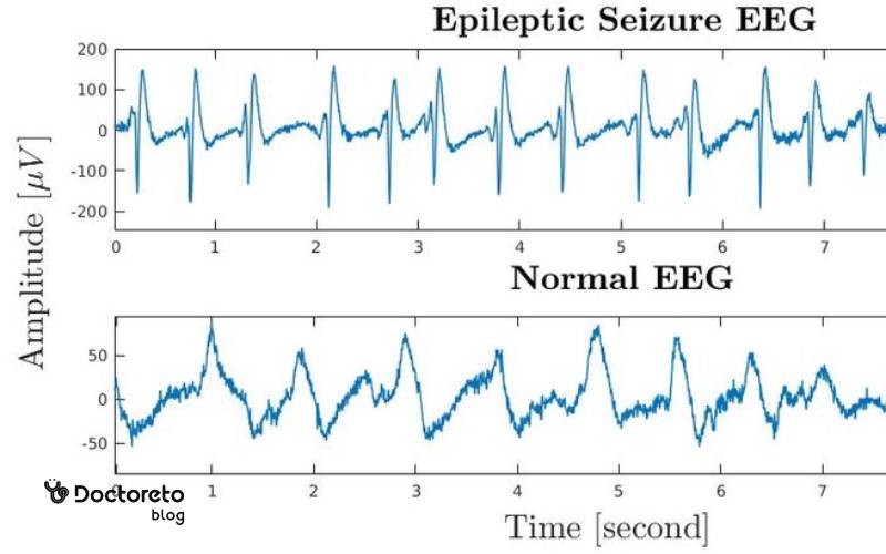 بيماري صرع عکس نوار مغز تشنج