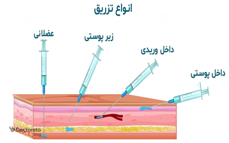 نحوه تزریق آمپول هپارین سدیم چگونه است؟