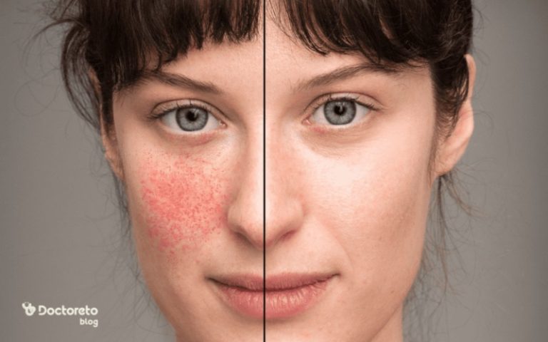بیماری لوپوس چیست؟