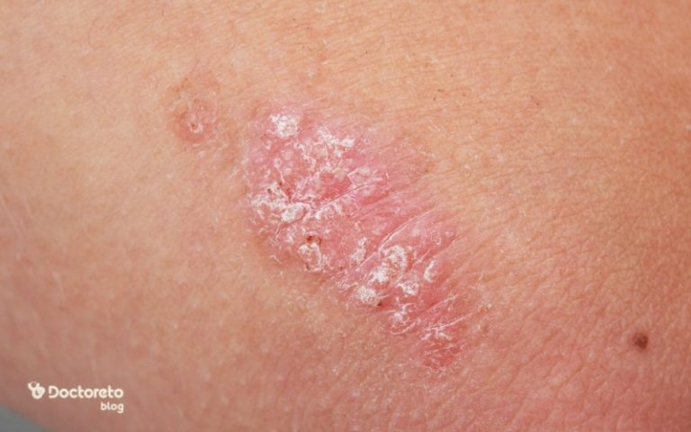 بیماری پسوریازیس چه نشانه هایی دارد و چگونه تشخیص داده میشود؟