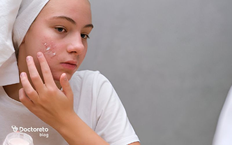 پماد تتراسایکلین برای جوش