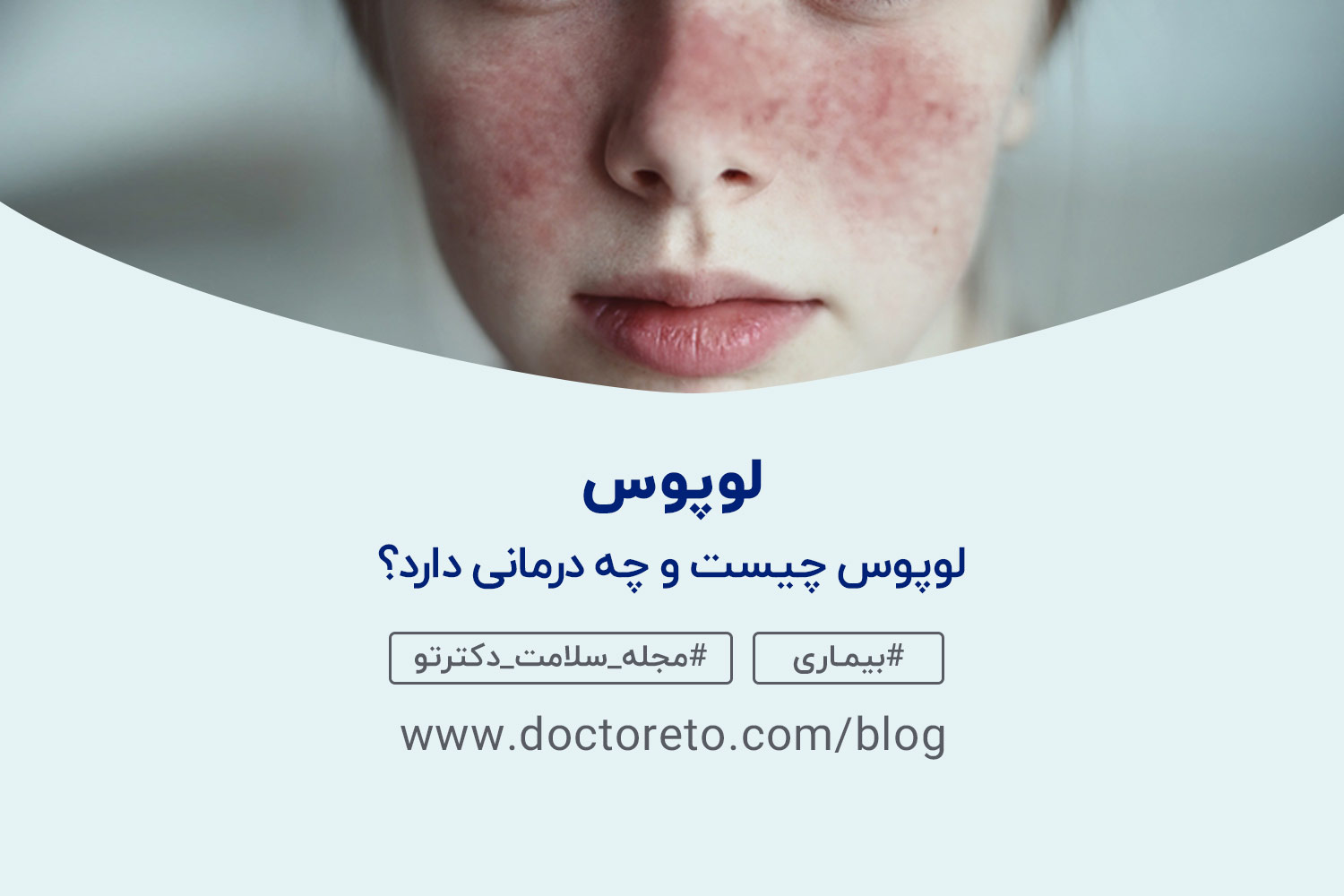 لوپوس بیماری لوپوس