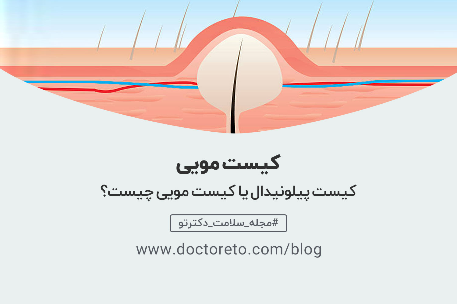 کیست مویی چیست و چطور می توان از آن خلاص شد؟