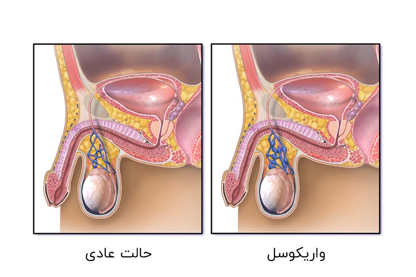 واریکوسل شبیه یک رگ واریسی است که ممکن است در پای خود مشاهده کنید.
