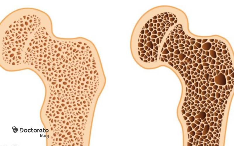عوارض پوکی استخوان چیست؟